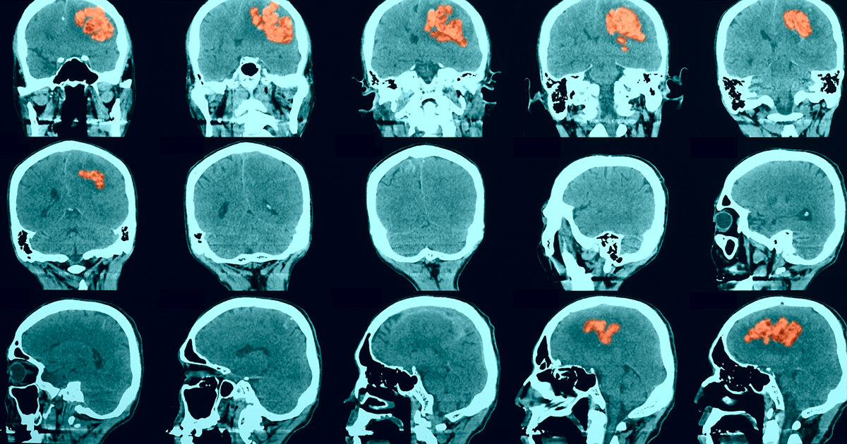 All About The Encephalitis Society and Why We're Supporting them at